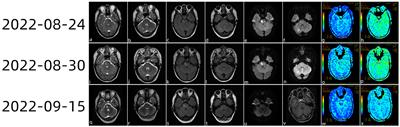 Case report: A case of abrupt stroke as the first symptom of neurobrucellosis